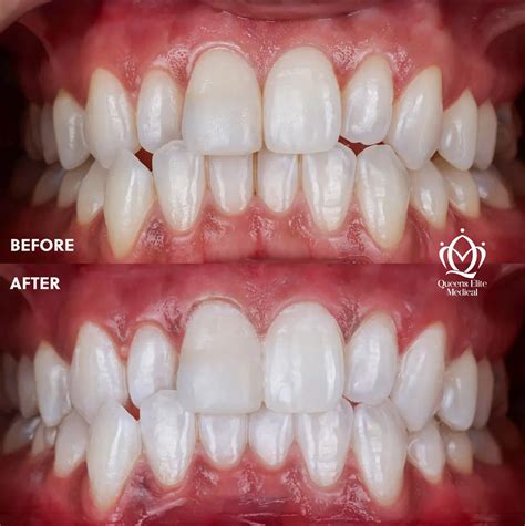 Ultimate Teeth Whitening Treatment Dubai Revealed