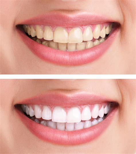 Best Teeth Whitening Treatment Financing Choices Revealed