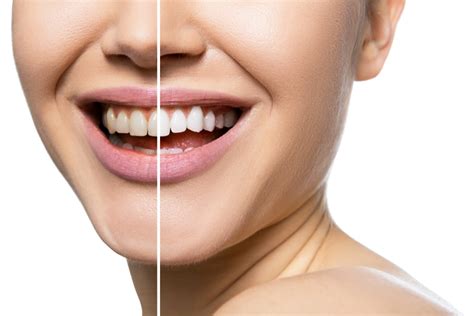 Teeth Whitening Treatment Los Angeles Achieve Brighter Smiles Today