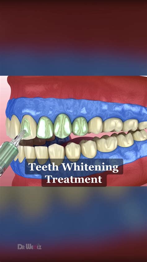 Discover the Ultimate Teeth Whitening Treatment Procedure Explained