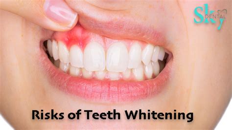 Teeth Whitening Treatment Risks Uncovered Professional Insights and Warnings
