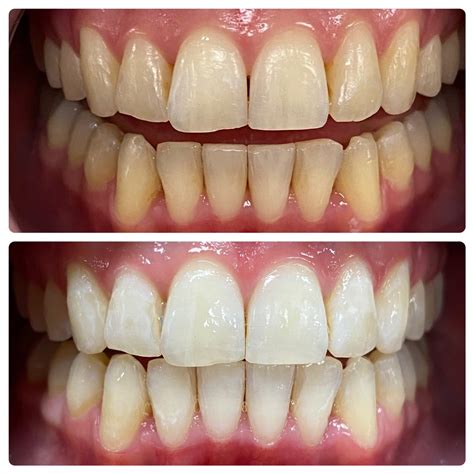 Teeth Whitening Treatment Toronto: Achieve Brighter Smiles Today
