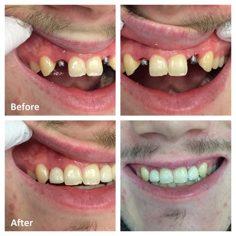 Transform Your Smile: Remarkable Tooth Care Before and After Results