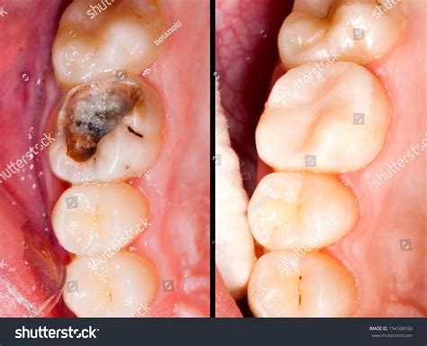 Tooth Decay Before and After: Real Transformations!