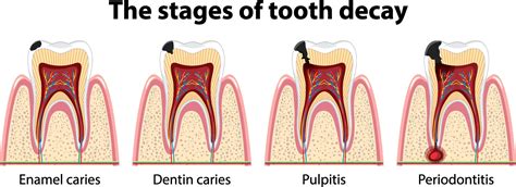 Tooth Decay Benefits: Surprising Oral Health Upside