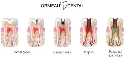 Ultimate Tooth Decay Guide for Healthy Smiles