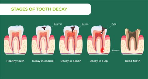 Top Tooth Decay Mistakes to Avoid for a Healthier Smile