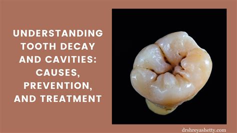 Top Tooth Decay Tips: Prevent Fast!