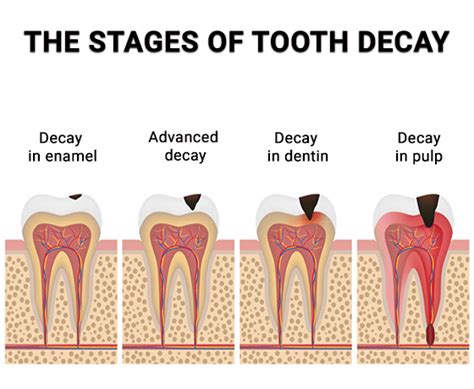 Best Tooth Decay Treatment: Fast, Effective Solutions