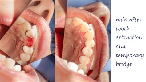 Tooth Extraction Cost: Before & After Analysis