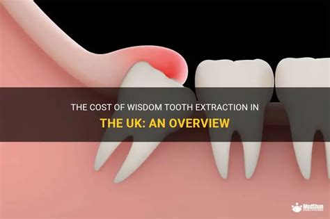 Decoding Tooth Extraction Cost in UK 2023