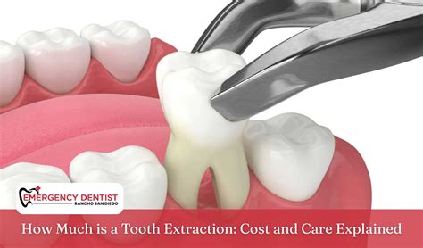 Tooth Extraction Cost Procedure Explained Simply: What You Need to Know