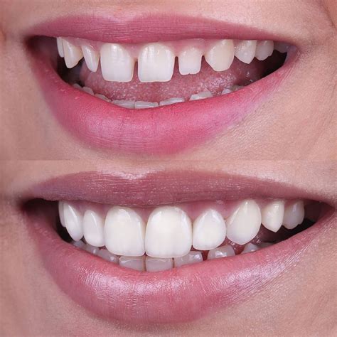 Veneers for Teeth: 24-Hour Service Miracle