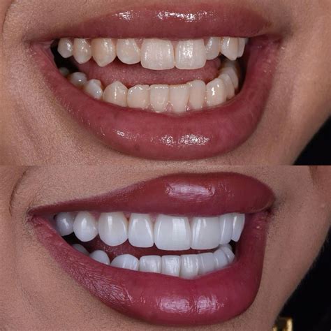 Veneers for Teeth Los Angeles: Transform Smiles Fast!
