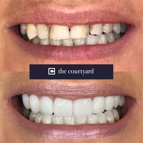 Veneers for Teeth UK: Achieve Flawless Smiles Today
