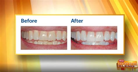 Top Dentist Advice for Whitening Teeth Effectively