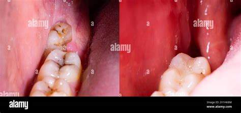 Wisdom Tooth Removal: Stunning Before and After Transformations