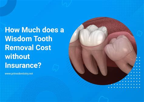 Wisdom Tooth Removal: Top Canada Guide