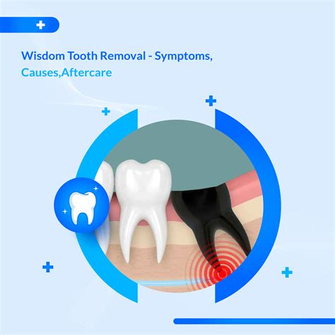 Best Wisdom Tooth Removal in Dubai