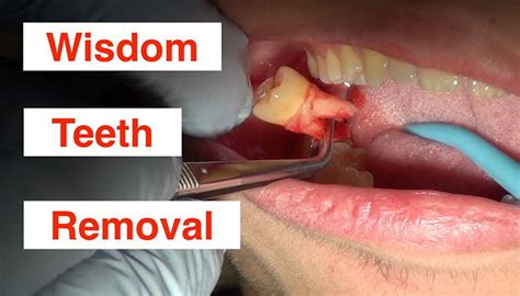 Best Wisdom Tooth Removal Financing Deals