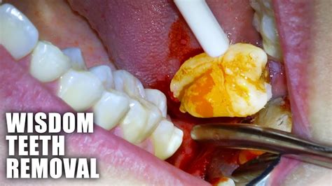Wisdom Tooth Removal Procedure: Clear and Concise Guide for Patients
