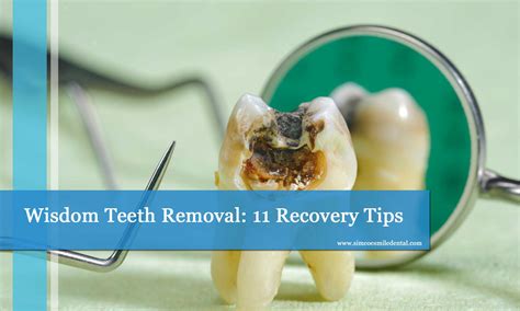 Wisdom Tooth Removal: Same Day Appointment Options