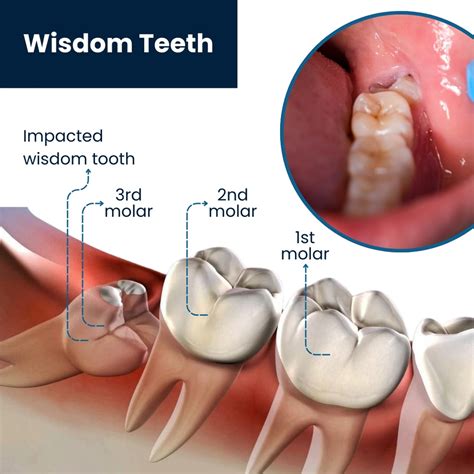 Best Wisdom Tooth Removal by Top Dentist