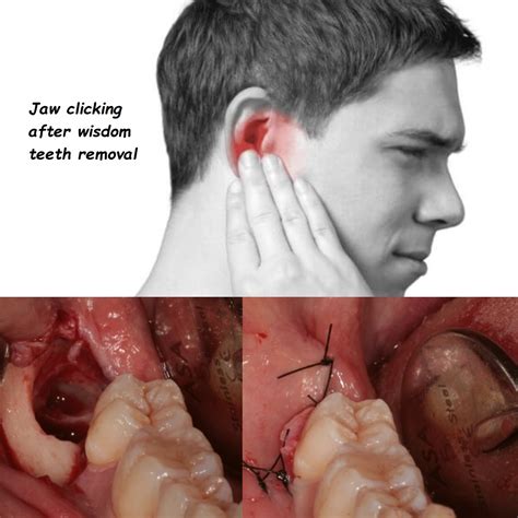 Wisdom Tooth Removal USA: Top Clinics and Expert Advice