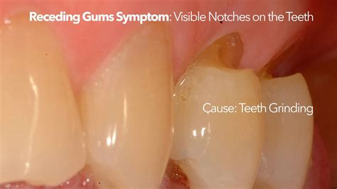 What Are The Worst Foods For Receding Gums And How To Avoid Them