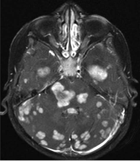 Xanthogranuloma In The Brain Explained: Symptoms And Treatment Options