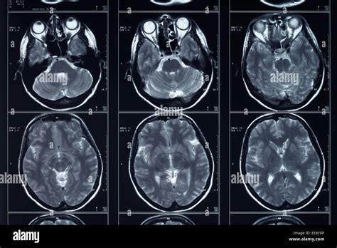 Understanding Xray In The Brain: What You Should Know